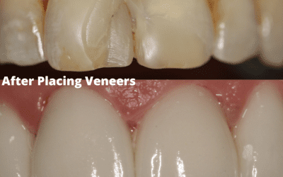 What are Veneers?