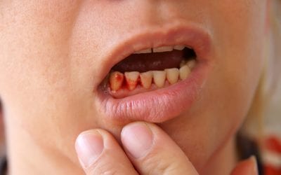 5 Reasons Your Gums May Be Bleeding